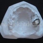 The Band and Loop Appliance is used as a space maintainer to preserve space which may have been created from loss or extraction of primary dentition.
