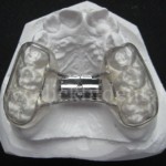 Bonded Rapid Maxillary Expansion Appliance is similar to a R.M.E although has a  framework encircling all of the posterior teeth and 
supports the acrylic posterior bite plane.
