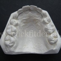 Fixed Retainer is used to maintain position of maxillary or mandibular anterior dentition