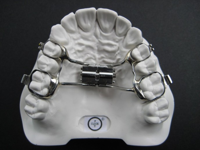 Rapid Maxillary Expansion or Hyrax Appliance increases the width of the upper jaw by separating the bone suture between the two halves of the palate.